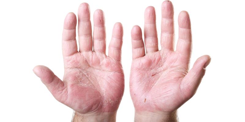 rửa bát có thể hại da tay